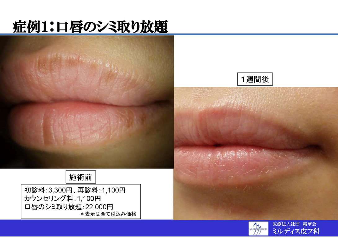 唇のシミ取り - 福岡市城南区の美容皮膚科 タケダスポーツ・ビューティークリニック
