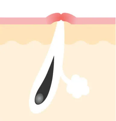 赤みの原因
