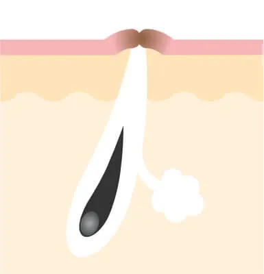 色素沈着の原因