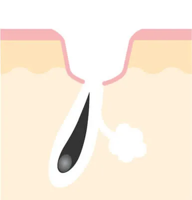 へこみ・陥没の原因