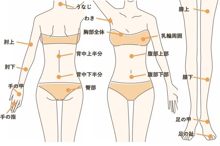 蓄熱式医療脱毛　全身脱毛5回コース