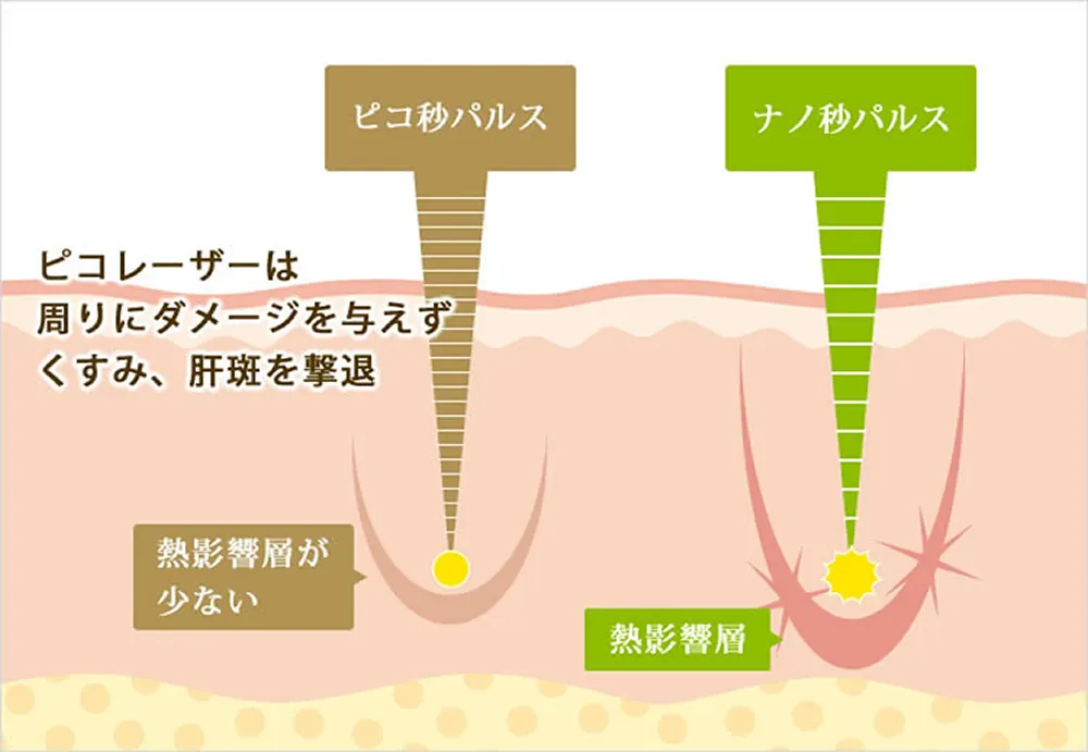 ピコトーニング