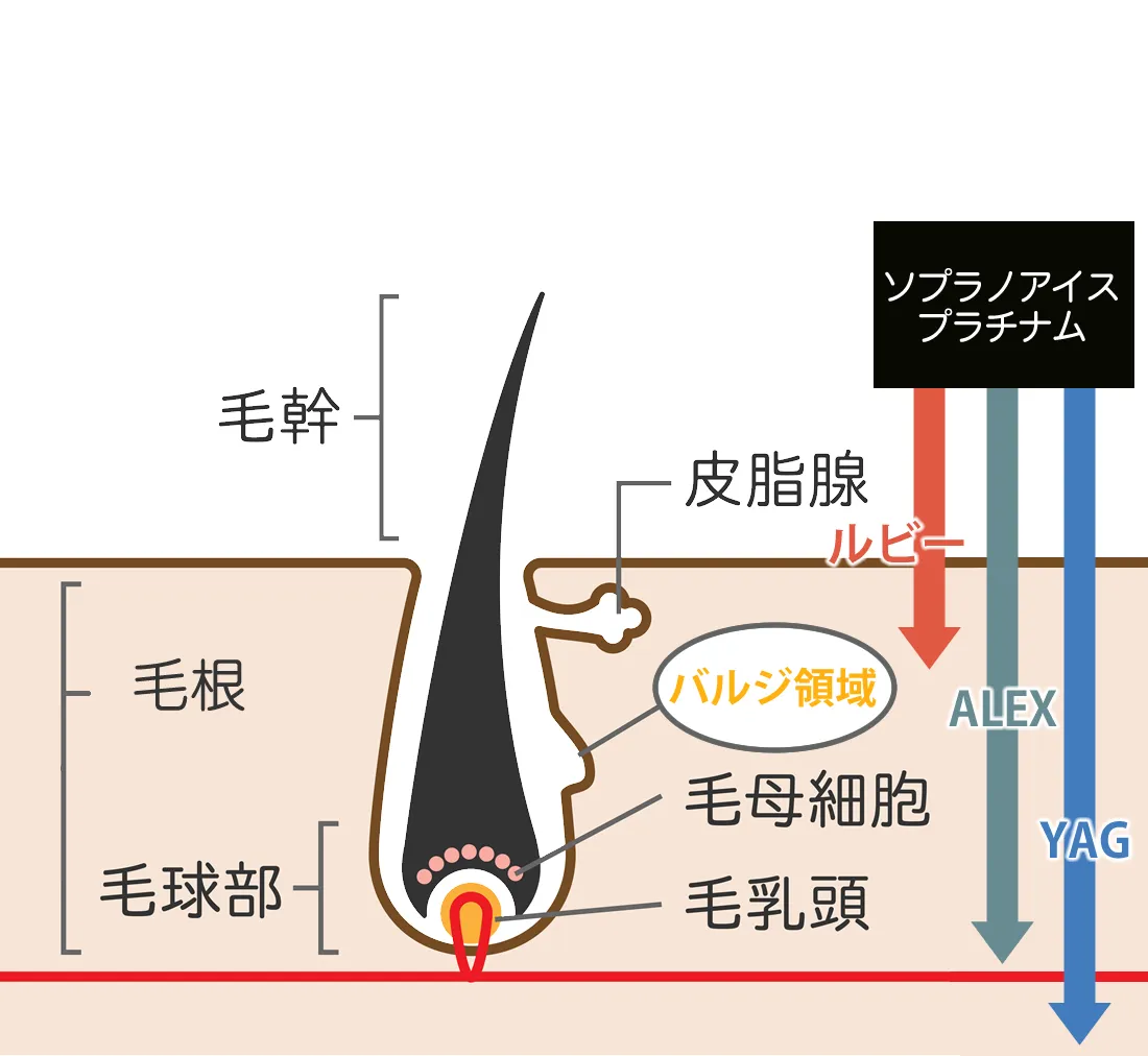 蓄熱式脱毛の原理