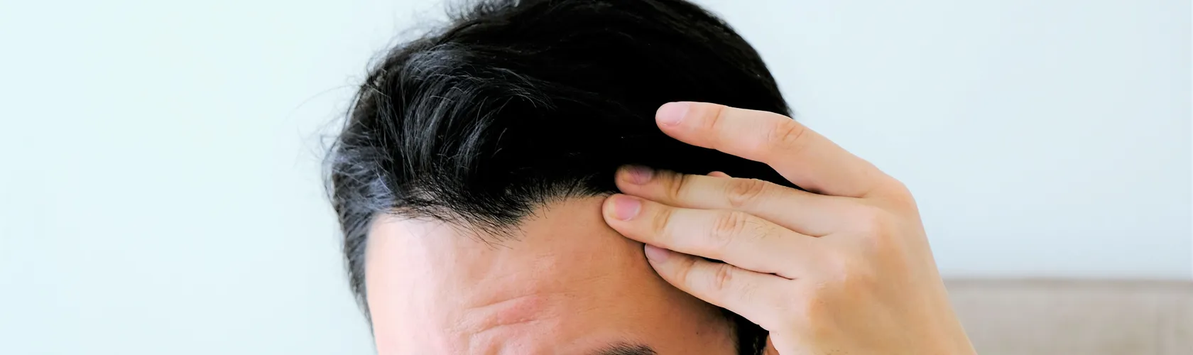 男性型脱毛症（AGA：Androgenetic Alopecia）