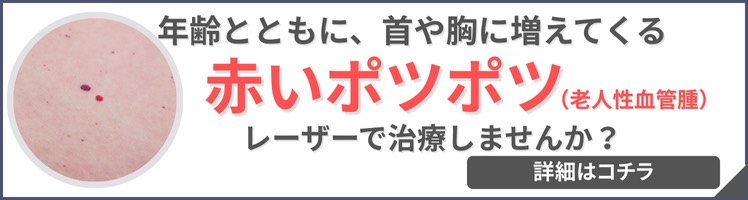 老人性血管腫レーザー