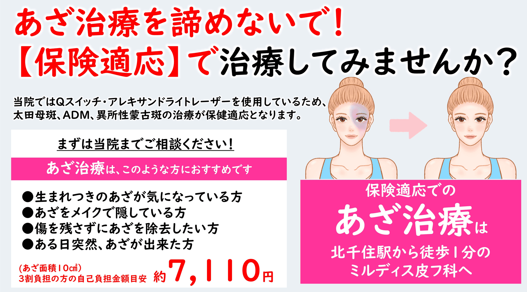 アザ（太田母斑）のレーザー治療について
